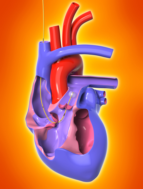 heart attack diagram. A heart attack strikes when